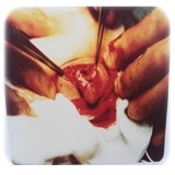 圖：紀念照片西元1979年12月1日女性假性半陰陽人，手術陰莖包埋術中